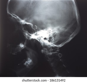 X-ray, Human Head, Bone