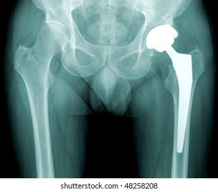 X-ray Of A Human Hip, Joint Replacement, Hip Pain