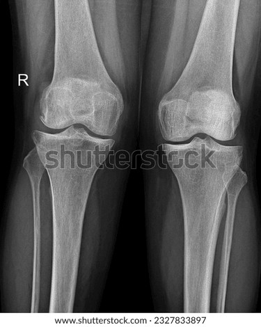 X-ray of the human knee joint, capturing the femur, tibia, patella, and menisci, assisting in diagnosing knee injuries and degenerative changes