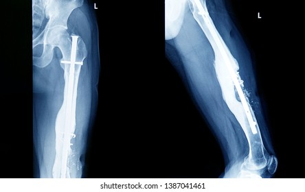 Trauma Fracture Images Stock Photos Vectors Shutterstock