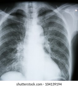 Xray Lungs Miliary Tuberculosis Small Spots Stock Photo (Edit Now ...