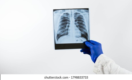 X-ray of human lungs on a white background in the hands of a doctor.Pneumonia of the lungs, infection,a medical professional is engaged in x-ray diffraction,diagnoses and concludes the patient. - Shutterstock ID 1798833733