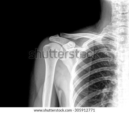 Xray Human Shoulder Stock Photo (Edit Now) 305912771 - Shutterstock