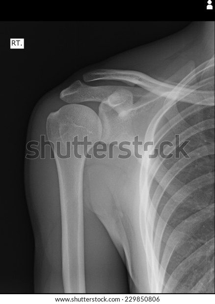 Xray Human Shoulder Stock Photo (Edit Now) 229850806