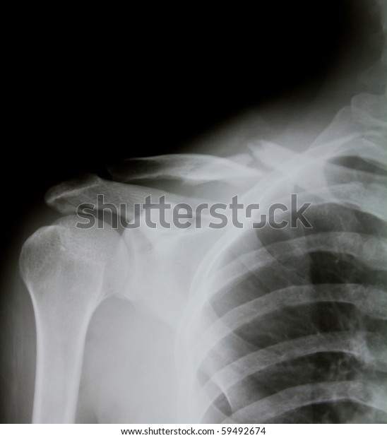 Xray Human Shoulder Broken Shoulder Stock Photo (Edit Now) 59492674