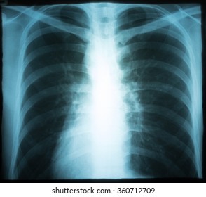 Xray Human Thorax Chest Stock Photo 360712709 | Shutterstock