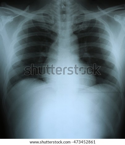 Xray of a human thorax (chest).