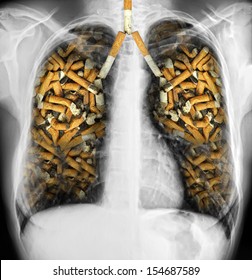 X-ray of a human thorax with effects of cigarette smoking - lung cancer - Shutterstock ID 154687589