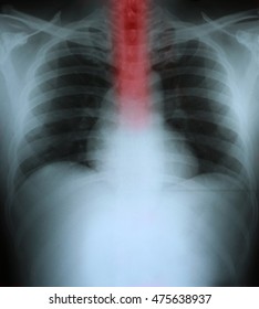 Xray Of A Human Thorax With Esophagus Highlighted In Red