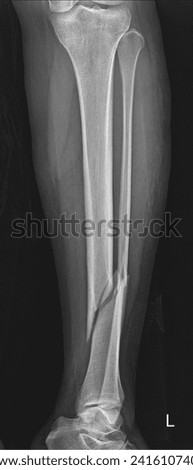 X-ray human tibia and fibula Lateral view