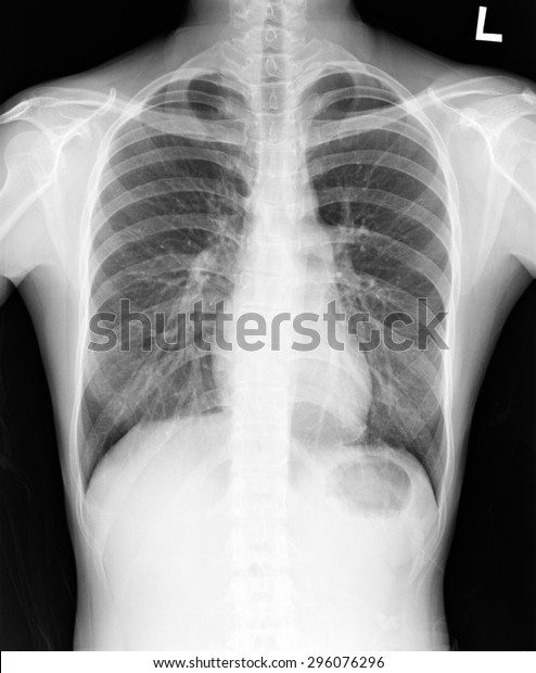 Xray Human Torax Isolated Stock Photo 296076296 | Shutterstock