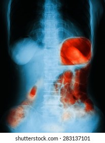 X-ray Image Of Abdomen Pain, Upright View. Shows Gastrointestinal Bleeding Or GI Bleeding