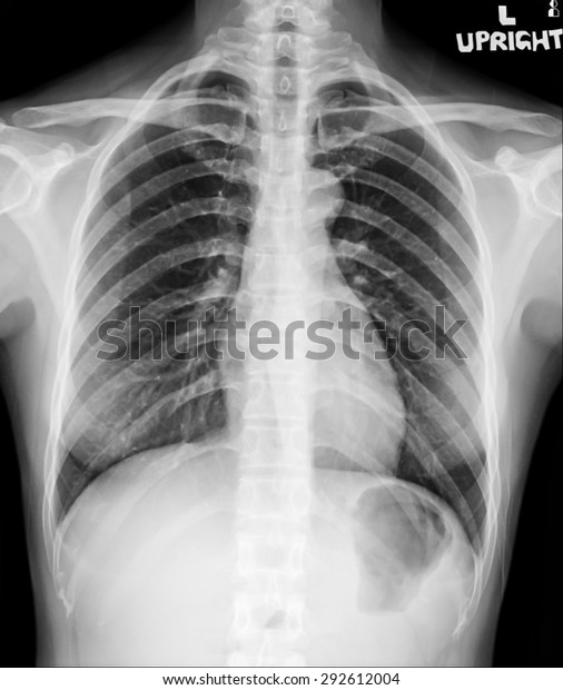 Xray Image Abdomen Supine Position Stock Photo 292612004 | Shutterstock