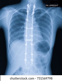 X-ray Image Of Adult Patient Spine Show Scoliosis Surgery Fix By Long Metal Rod And Many Screw For Spinal Bend In Adult People.  Adult Scoliosis Fix Medical Concept.