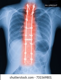 X-ray Image Of Adult Patient Spine Show Scoliosis Surgery Fix By Long Metal Rod And Many Screw For Spinal Bend In Adult People.  Adult Scoliosis Fix Medical Concept.