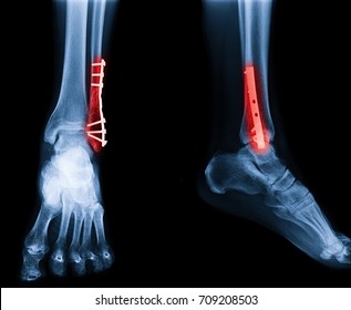 broken heel x ray