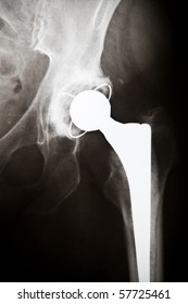 X-ray Image Of An Artificial Hip