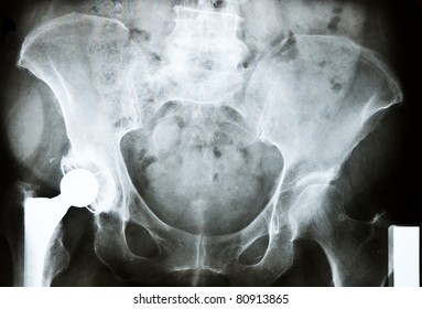 X-ray Image Of An Artificial Hip