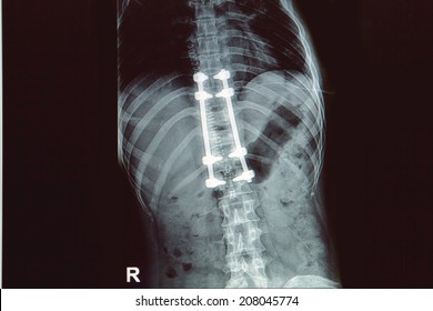 X-ray Image Of Back Pain  Show Spinal Column With Implant, Screw Placement And Fusion