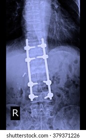 X-ray Image Of Back Pain Show Spinal Column With Implant, Screw Placement And Fusion