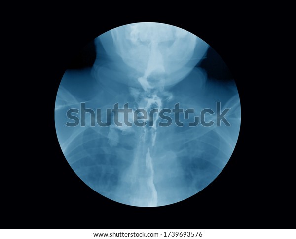 Xray Image Barium Meal Examination Upper Stock Photo 1739693576 ...