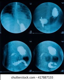 X-ray Image Of Barium Meal, Upper Gastrointestinal Series(UGI), A 72 Year Old Women