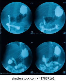 X-ray Image Of Barium Meal, Upper Gastrointestinal Series(UGI), A 72 Year Old Women