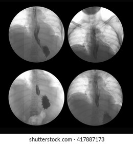 X-ray Image Of Barium Meal, Upper Gastrointestinal Series(UGI), A 72 Year Old Women