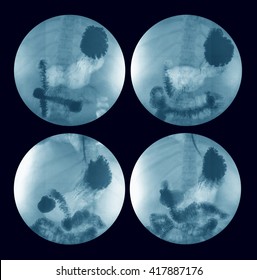 X-ray Image Of Barium Meal, Upper Gastrointestinal Series(UGI), A 72 Year Old Women