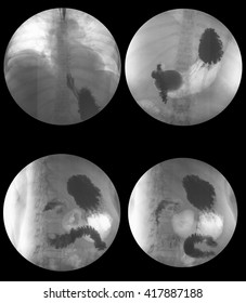 X-ray Image Of Barium Meal, Upper Gastrointestinal Series(UGI), A 72 Year Old Women