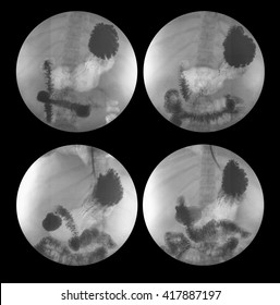 X-ray Image Of Barium Meal, Upper Gastrointestinal Series(UGI), A 72 Year Old Women