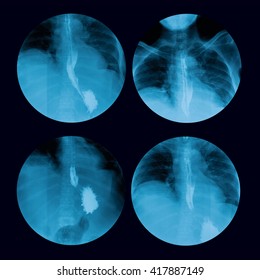 X-ray Image Of Barium Swallowing, Upper Gastrointestinal Series(UGI), A 72 Year Old Women