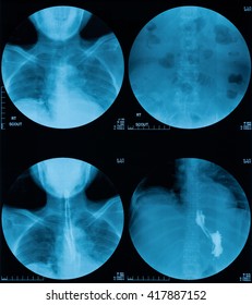 X-ray Image Of Barium Swallowing, Upper Gastrointestinal Series(UGI), A 72 Year Old Women