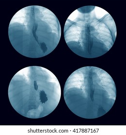 X-ray Image Of Barium Swallowing, Upper Gastrointestinal Series(UGI), A 72 Year Old Women