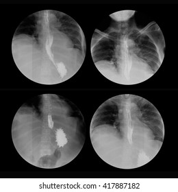 X-ray Image Of Barium Swallowing, Upper Gastrointestinal Series(UGI), A 72 Year Old Women