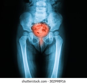 X-ray image of bladder, Showing cystitis or lower urinary tract infection - Shutterstock ID 302998916