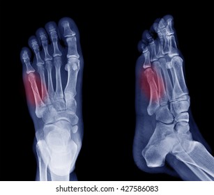 X-ray Image Of Bone Fracture At 5th Metatarsal  Left Foot 