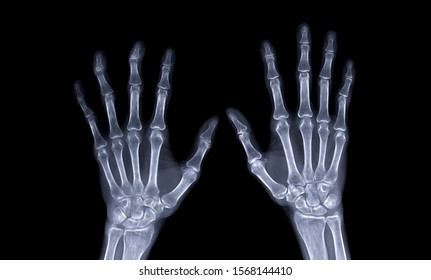 xray image of both hand AP view isolated on black  background  for diagnostic rheumatoid. - Shutterstock ID 1568144410