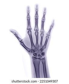 xray image of both hand AP view isolated on white background  for diagnostic rheumatoid. - Shutterstock ID 2251049307