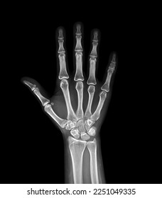xray image of both hand AP view isolated on black  background  for diagnostic rheumatoid. - Shutterstock ID 2251049335