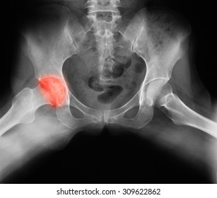 X-ray image of both hip, frog-leg view, showing hip osteoarthritis at the left side.