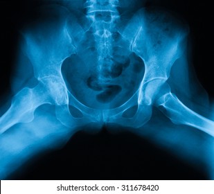 X-ray image of both hip, frog-leg Position, Showing right hip osteoarthritis.