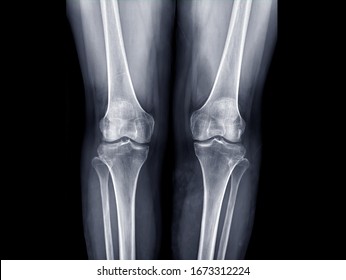 x-ray image of  both knee AP view for detect Osteoarthritis Knee or OA Knee .