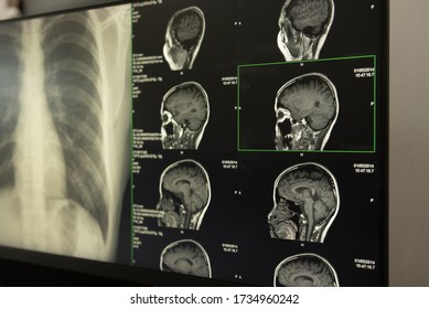 X-ray Image Brain And Chest Of Patient  By Computed Tomography, Mri For Medical Diagnosis.