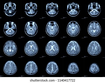 x-ray image brain or magnetic resonance image (mri scan) of patient.