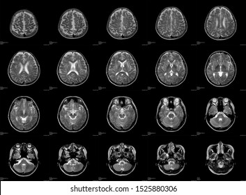 X-ray Image Brain Or Magnetic Resonance Image (mri Scan) Of Patient.