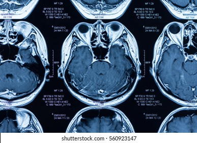 X-ray Image Brain Of Patient. Brain Scan By Mri.