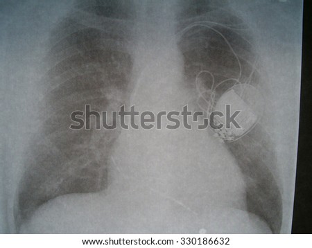 X-ray image of the breast. Heart with dilated cardiomyopathy. With implanted pacemaker system. Cardiac resynchronization therapy.
