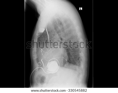 X-ray image of the breast. VergÃ?Â¶Ã??ertes heart with dilated cardiomyopathy. With implanted pacemaker system. Cardiac resynchronization therapy.
