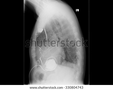 X-ray image of the breast. Verg?ertes heart with dilated cardiomyopathy. With implanted pacemaker system. Cardiac resynchronization therapy.